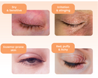 Four panels showing various symptoms of dry, sensitive, irritated, or eczema-prone eyelids and eyes.